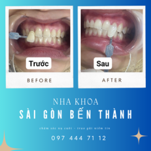 Nha Khoa Sài Gòn Bến Thành – Chăm sóc nụ cười, trao gửi niềm tin