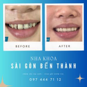 Nha Khoa Sài Gòn Bến Thành – Chăm sóc nụ cười, trao gửi niềm tin