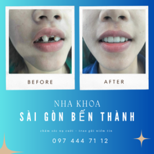 Nha Khoa Sài Gòn Bến Thành – Chăm sóc nụ cười, trao gửi niềm tin