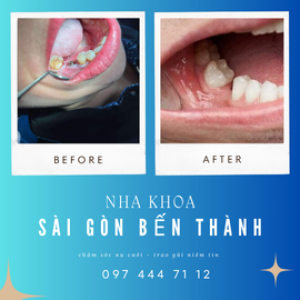 Nha Khoa Sài Gòn Bến Thành – Chăm sóc nụ cười, trao gửi niềm tin