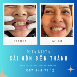 Nha Khoa Sài Gòn Bến Thành – Chăm sóc nụ cười, trao gửi niềm tin