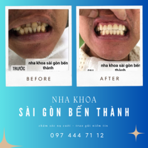 Nha Khoa Sài Gòn Bến Thành – Chăm sóc nụ cười, trao gửi niềm tin