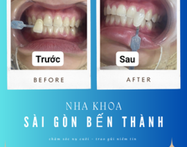 Ưu điểm kỹ thuật dán răng sứ Veneer