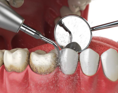 Cạo vôi răng tại Nha KHoa Sài Gòn Bến Thành 