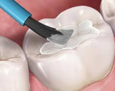 TRÁM RĂNG THẨM MỸ TẠI NHA KHOA SÀI GÒN BẾN THÀNH