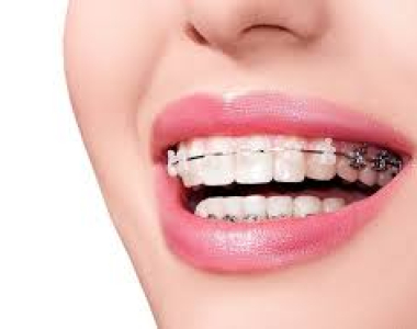 Hơn 90% Bạn Trẻ Bỏ Lỡ Thời Điểm Vàng Niềng Răng Đạt Kết Quả Tốt Nhất Vì Các Lý Do