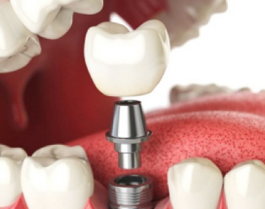 Trồng răng implant là gì? Khi nào nên trồng răng implant?